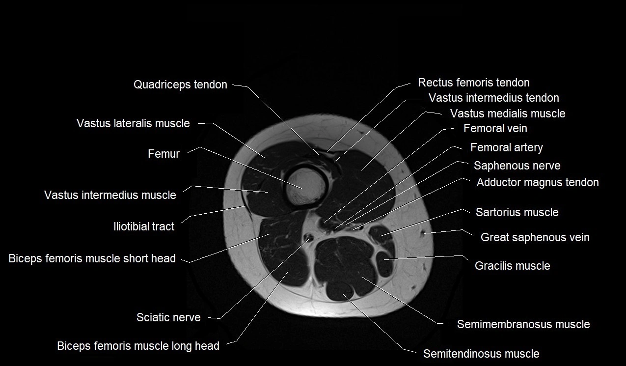 MRI thigh cross sectional anatomy image 45.webp